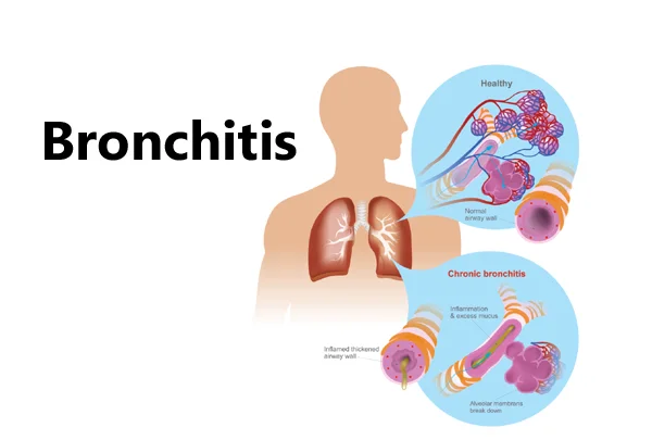 Bronchitis Asthma