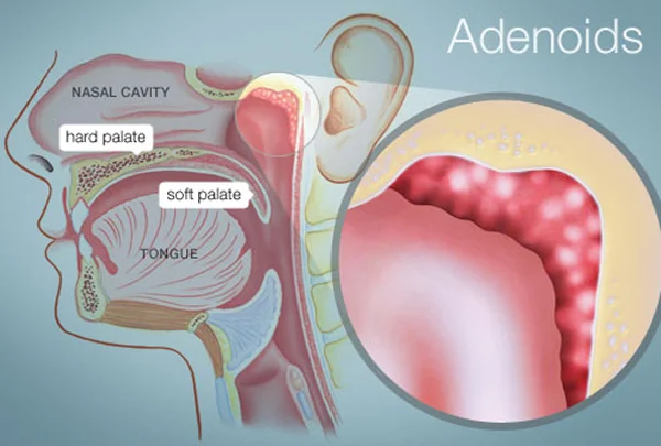 Adenoids