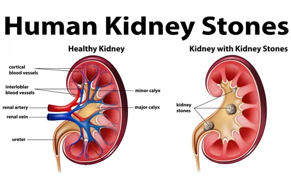Renal Calculi