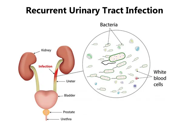 Recurrent UTI