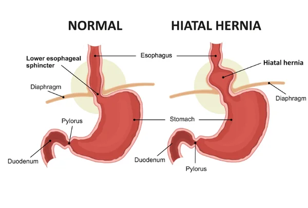 Hiatus Hernia