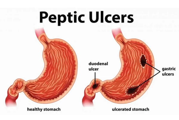 Peptic Ulcer