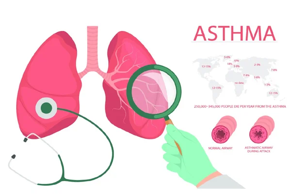 Asthma