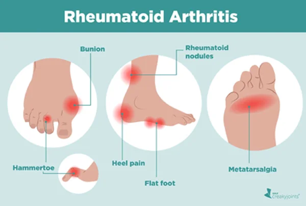 Rheumatoid Arthritis