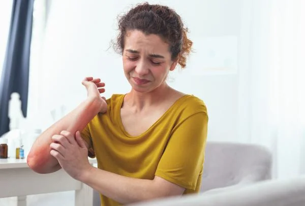 Eczema