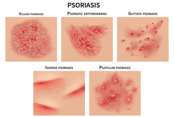 Psoriasis