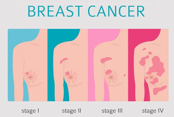 Breast Tumor
