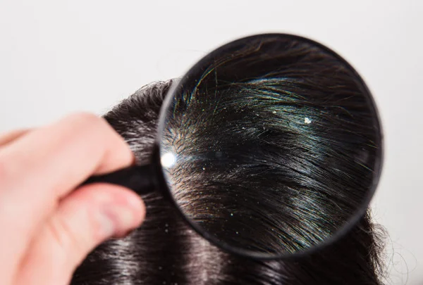 Dandruff